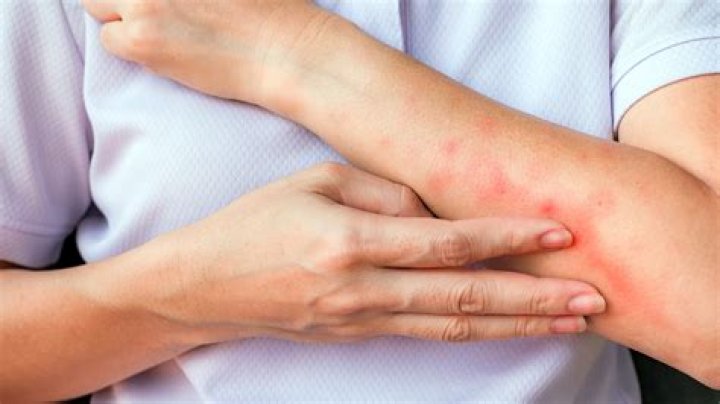How long does it take for mosquito bite scars to fade?